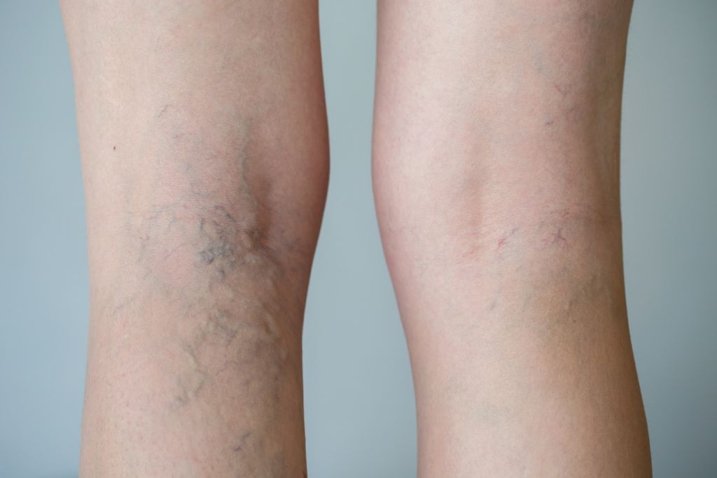 weird pregnancy symptoms varicose veins